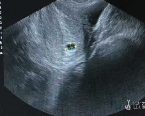 国内供卵试管排队时间,弓形子宫怀孕后得谨慎!6大注意事项助你安稳度过孕期